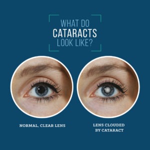 Cataract Treatment Chicago Northwest Indiana